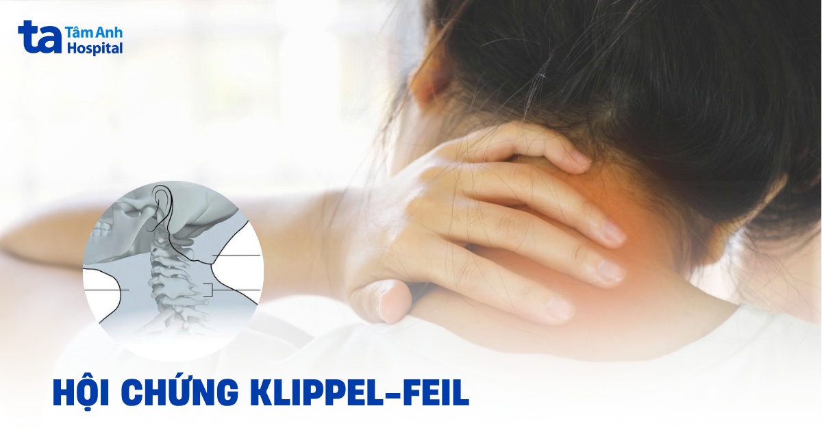 Hội chứng Klippel-Feil (KFS) là gì? Gây ảnh hưởng thế nào?