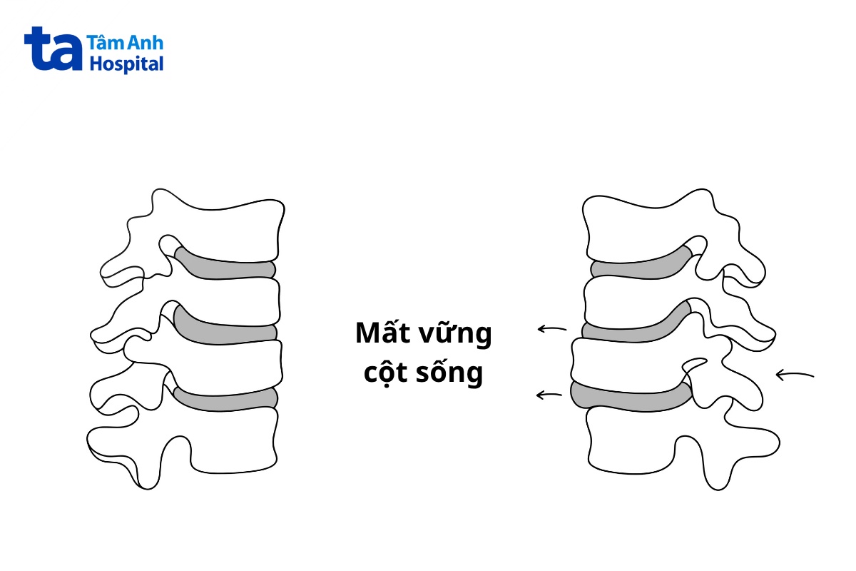 Mất vững cột sống gây đau nhức, khó chịu