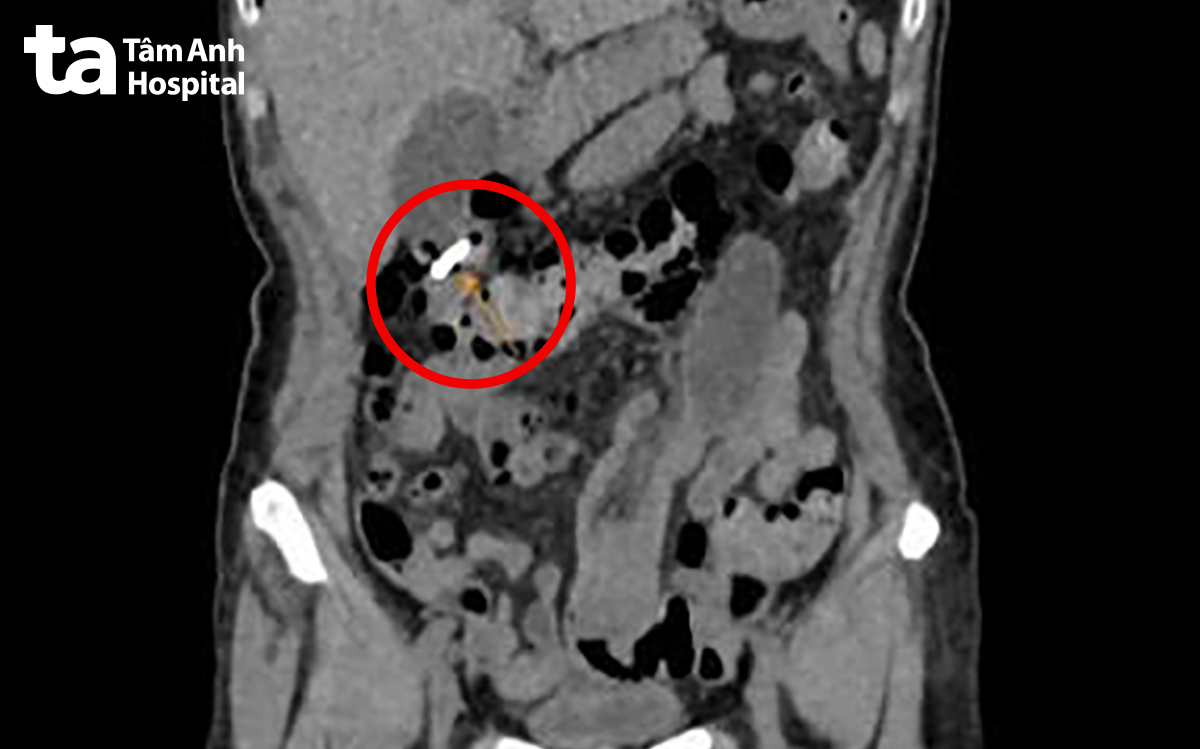 ảnh CT khối lồng ruột