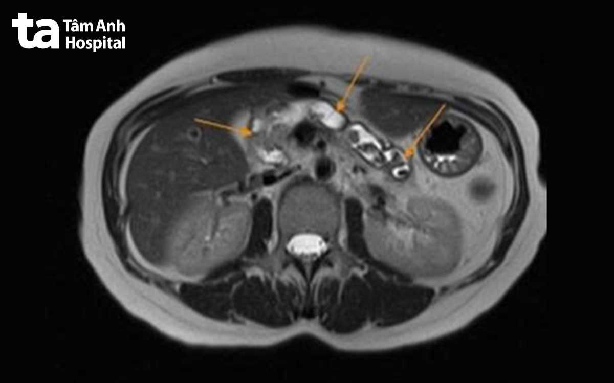 ảnh MRI sỏi ở tụy