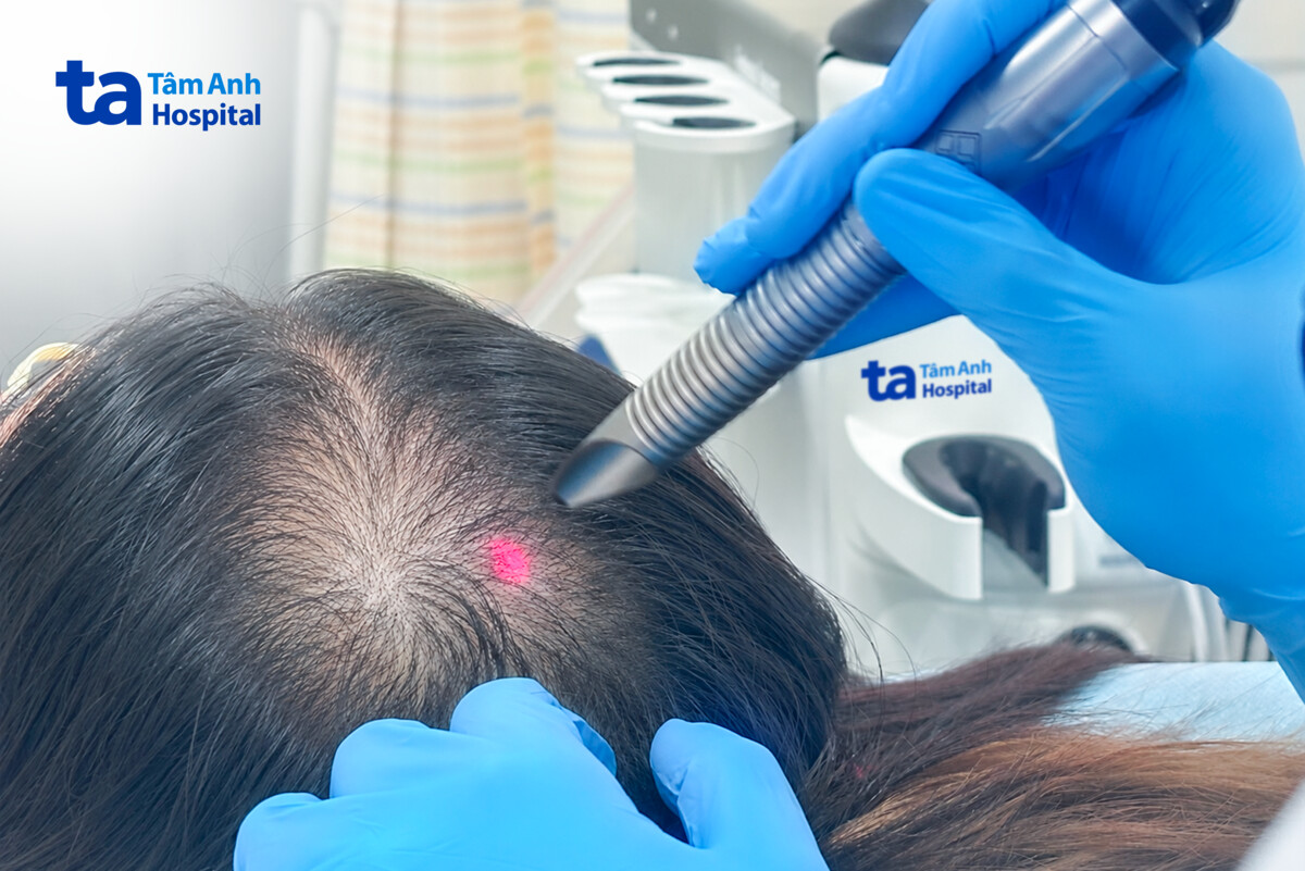 bác sĩ sử dụng laser 6d để kích thích nang tóc phục hồi