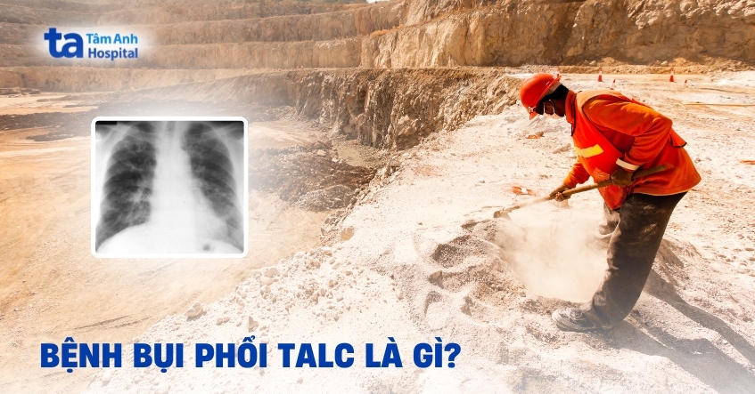 Bệnh Bụi Phổi Talc