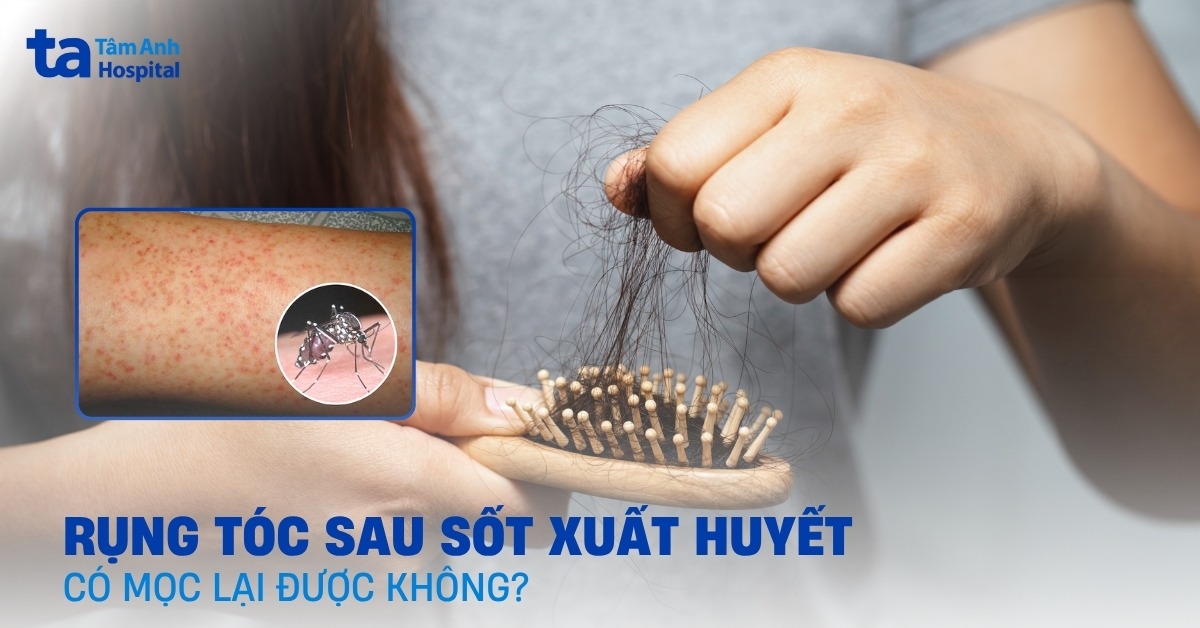 Bị rụng tóc sau khi bị sốt xuất huyết có mọc lại được không?