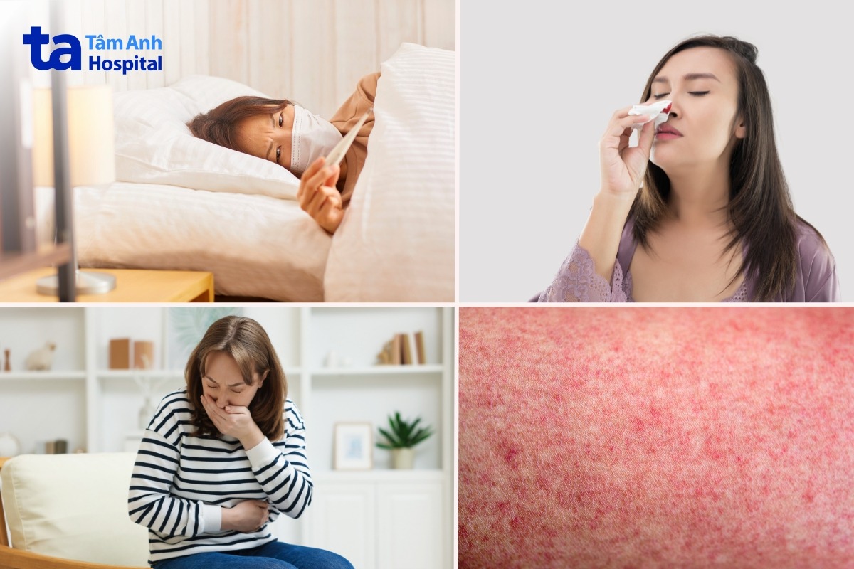 các triệu chứng đau bụng do sốt xuất huyết