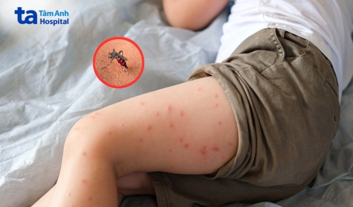 sốt xuất huyết bị nổi ban đỏ