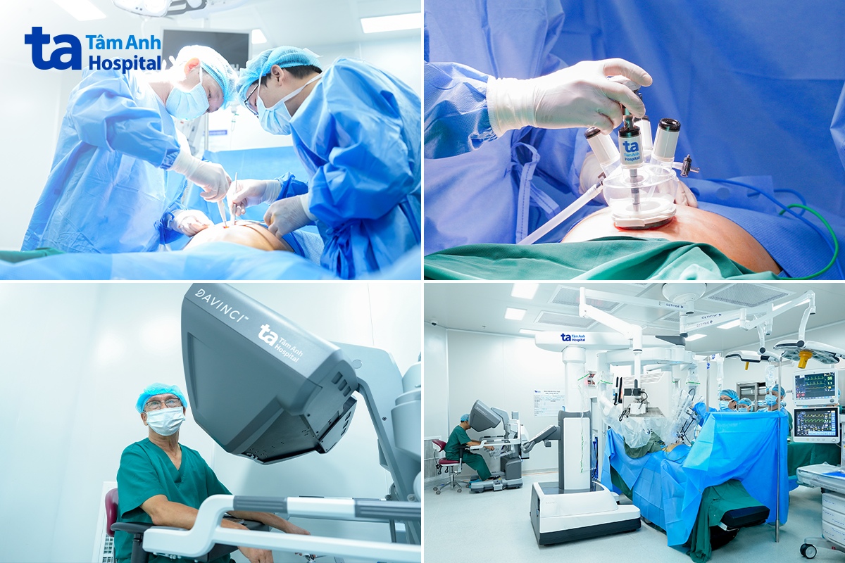 Toàn cảnh một ca phẫu thuật nội soi 1 vết mổ bằng Robot