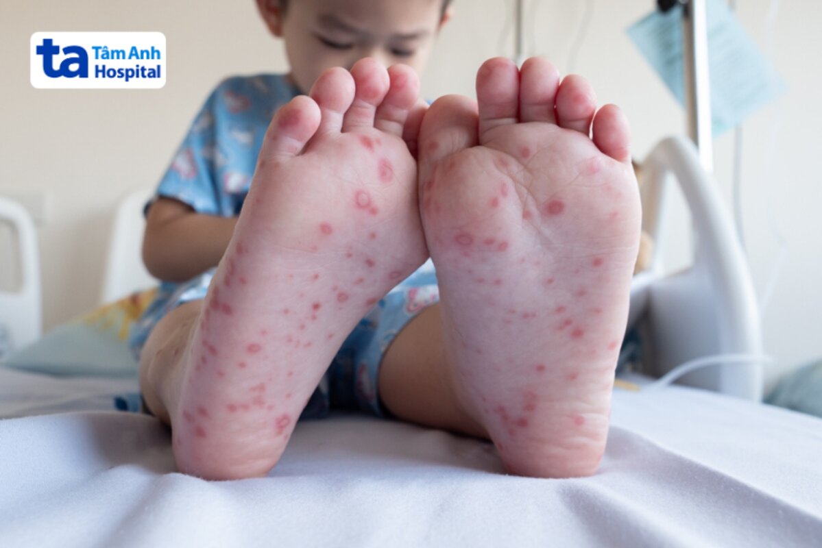 các bệnh lý viêm da virus ở trẻ thường gặp