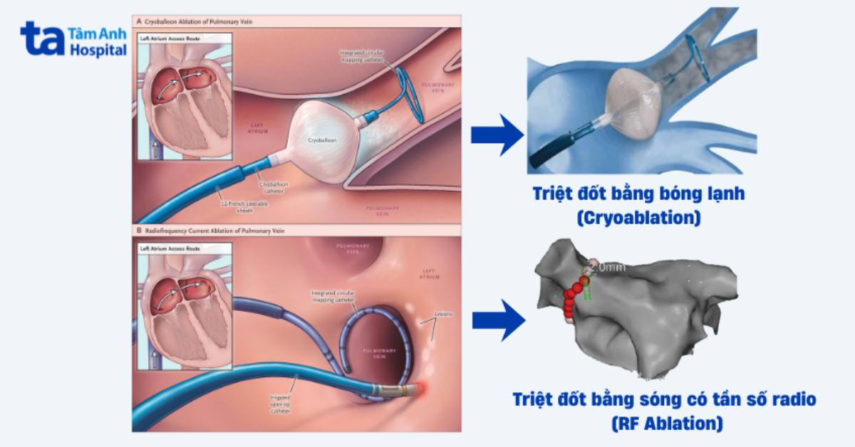 các phương pháp cô lập tĩnh mạch phổi phổ biến