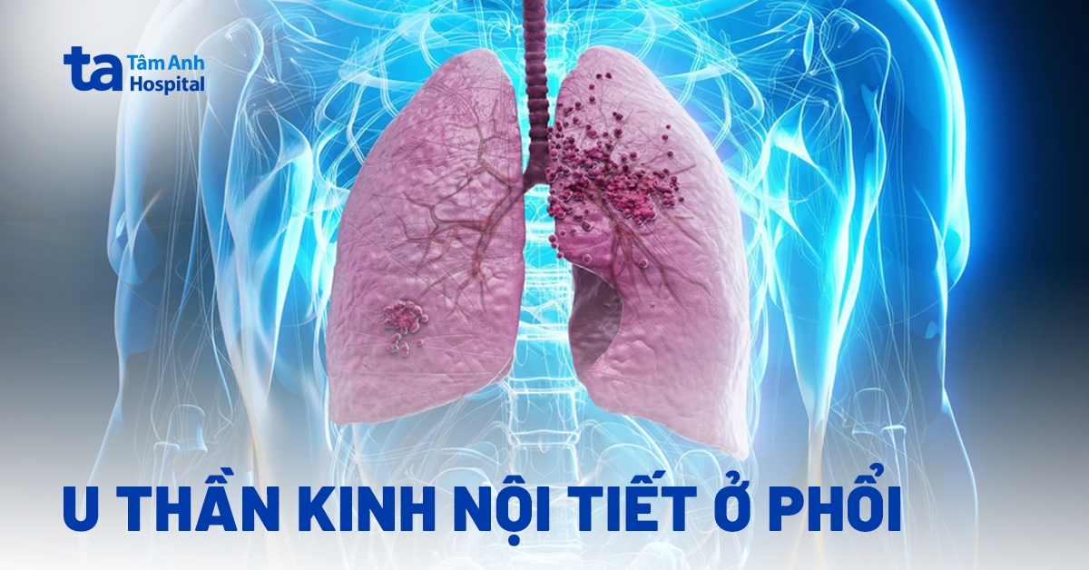 Các Thông Tin Về U Thần Kinh Nội Tiết Ở Phổi Các Thông Tin Về U Thần Kinh Nội Tiết Ở Phổi