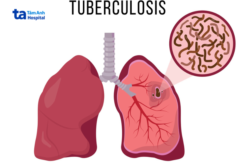 các tổn thương trong phổi còn nhỏ và nằm ở vị trí xa đường thở