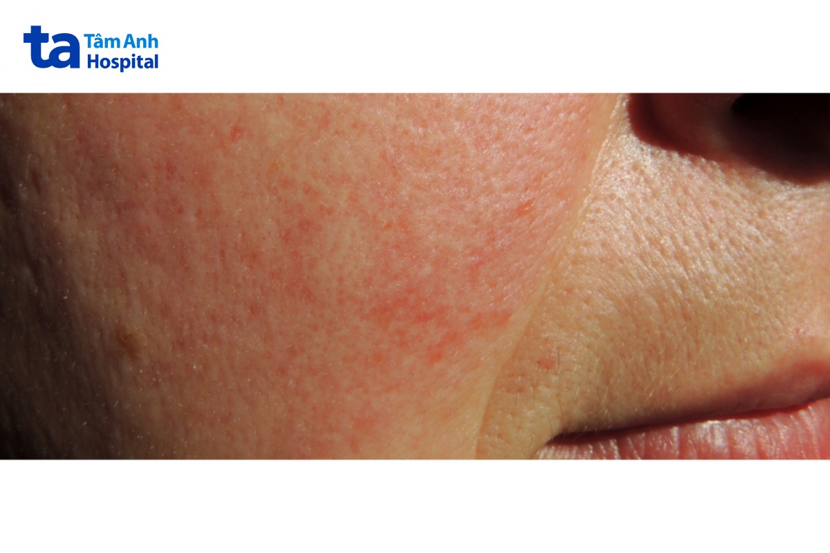 các yếu tố quyết định thời gian hồi phục nhiễm corticoid