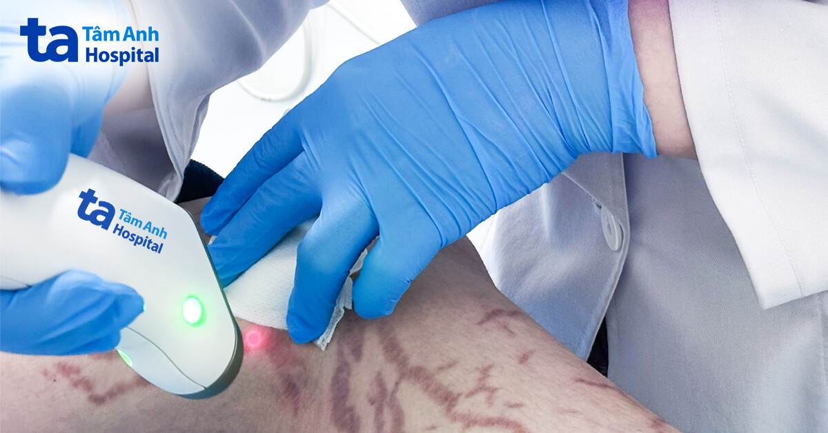 Cải thiện rạn da kéo dài sau điều trị laser 6D