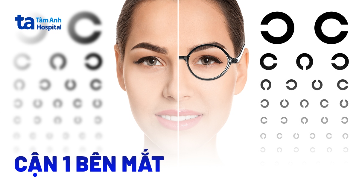 Bị cận 1 bên mắt: Nguyên nhân, triệu chứng và cách điều trị