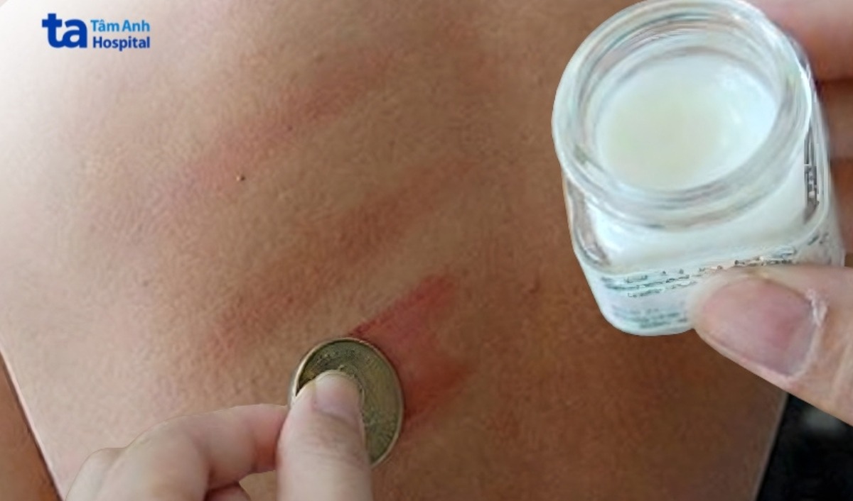 sốt virus không nên đánh cảm