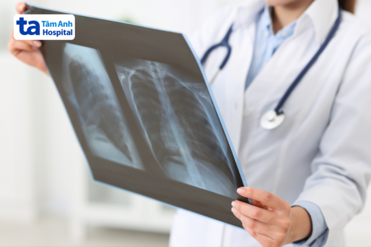 chẩn đoán nấm phổi bằng x quang
