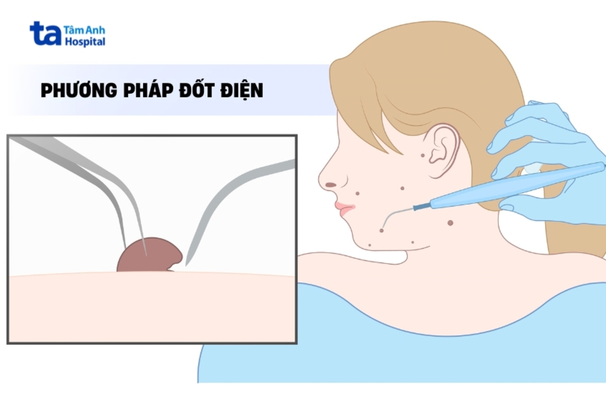 chỉ định trị u mềm treo bằng đốt điện
