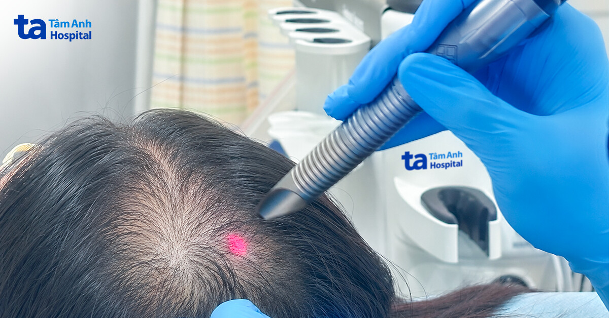 Cô gái 20 tuổi hói đầu do cường androgen