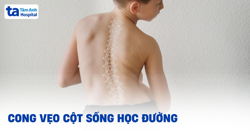 Cong vẹo cột sống học đường cần nhận biết sớm và phòng chống