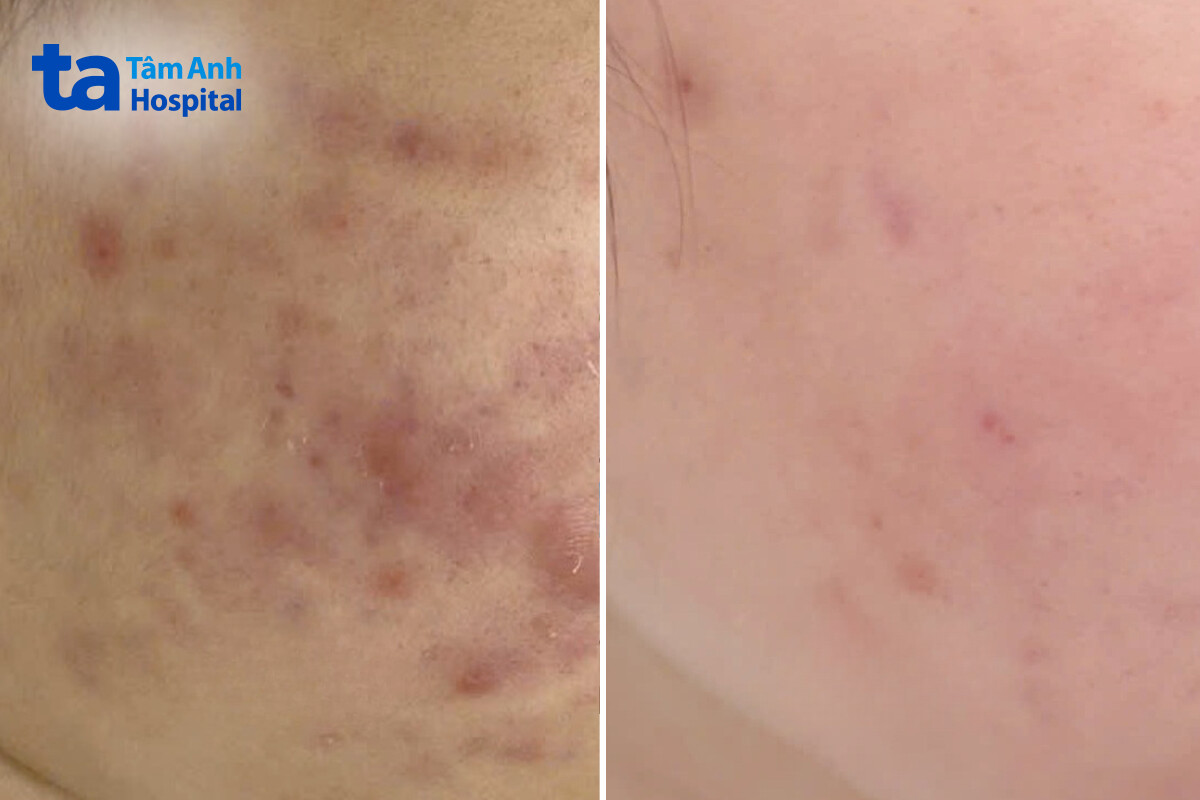 da của chị Mai đã kiểm soát được tình trạng viêm sau 2 tháng điều trị