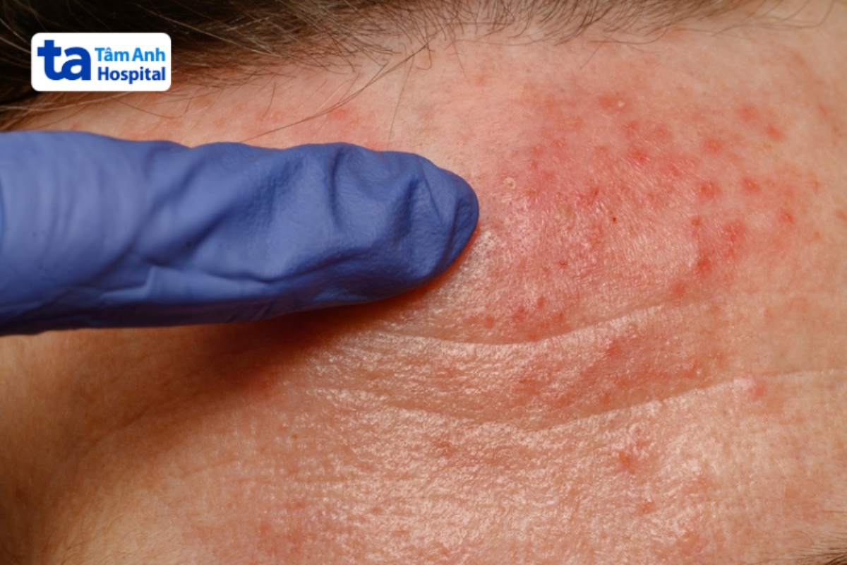da nổi mẩn đỏ do demodex
