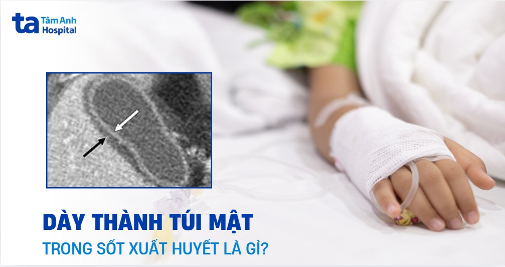Dày Thành Túi Mật Trong Sốt Xuất Huyết
