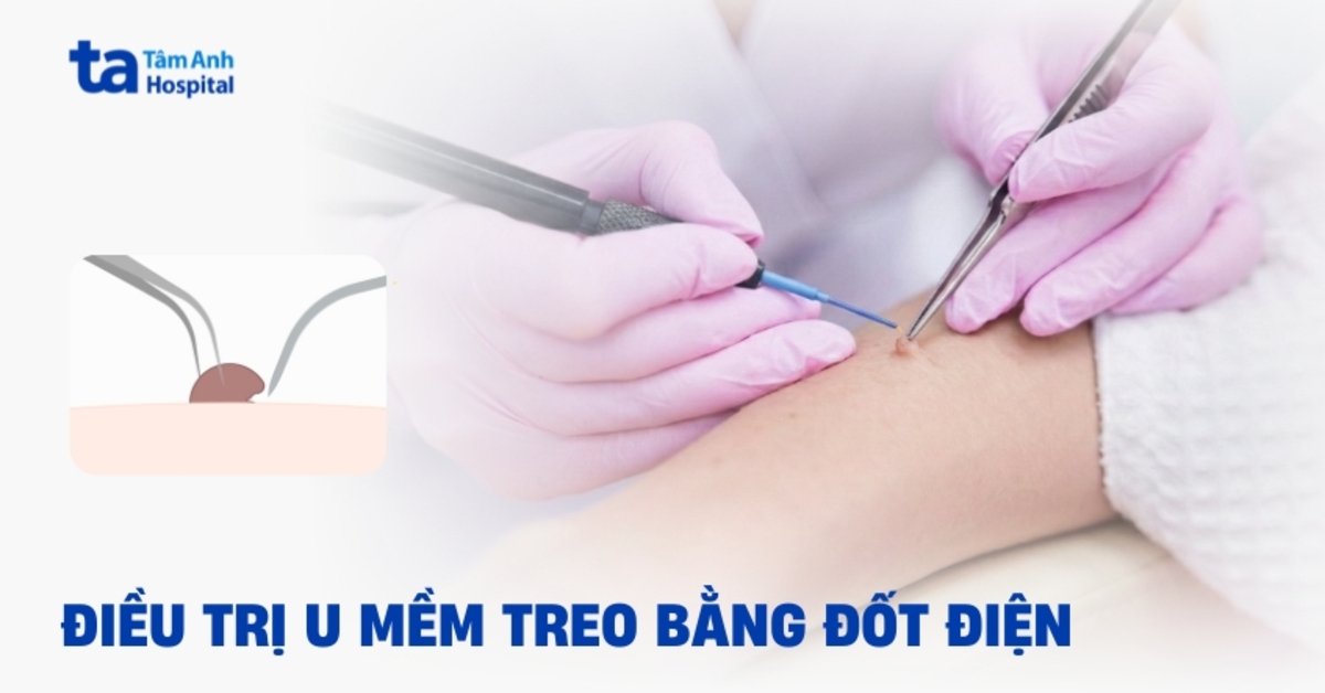 Điều trị u mềm treo bằng đốt điện cần lưu ý điều gì?