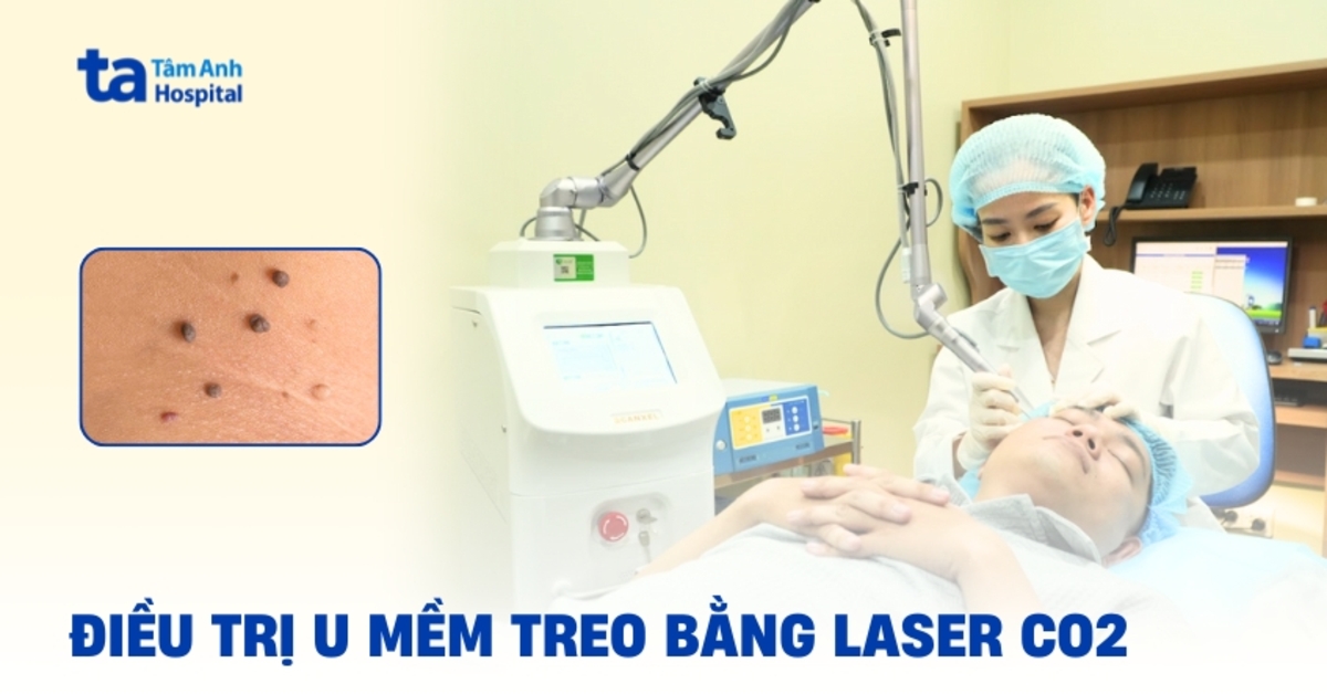 Điều trị u mềm treo bằng laser CO2: Quy trình, ưu nhược điểm