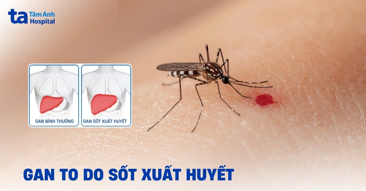 Giải đáp: Tại sao gan to trong sốt xuất huyết?