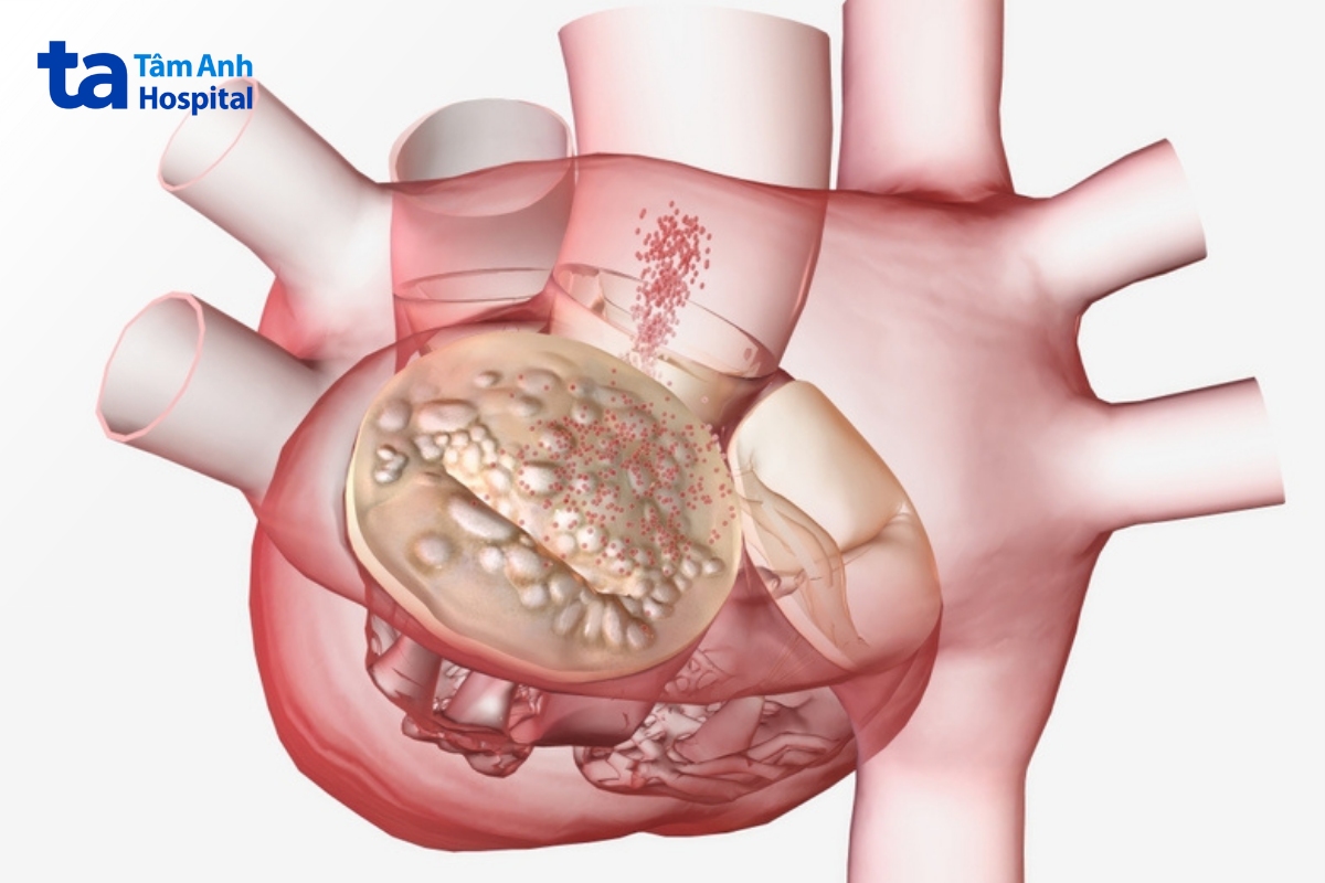 hẹp van động mạch phổi hai mảnh