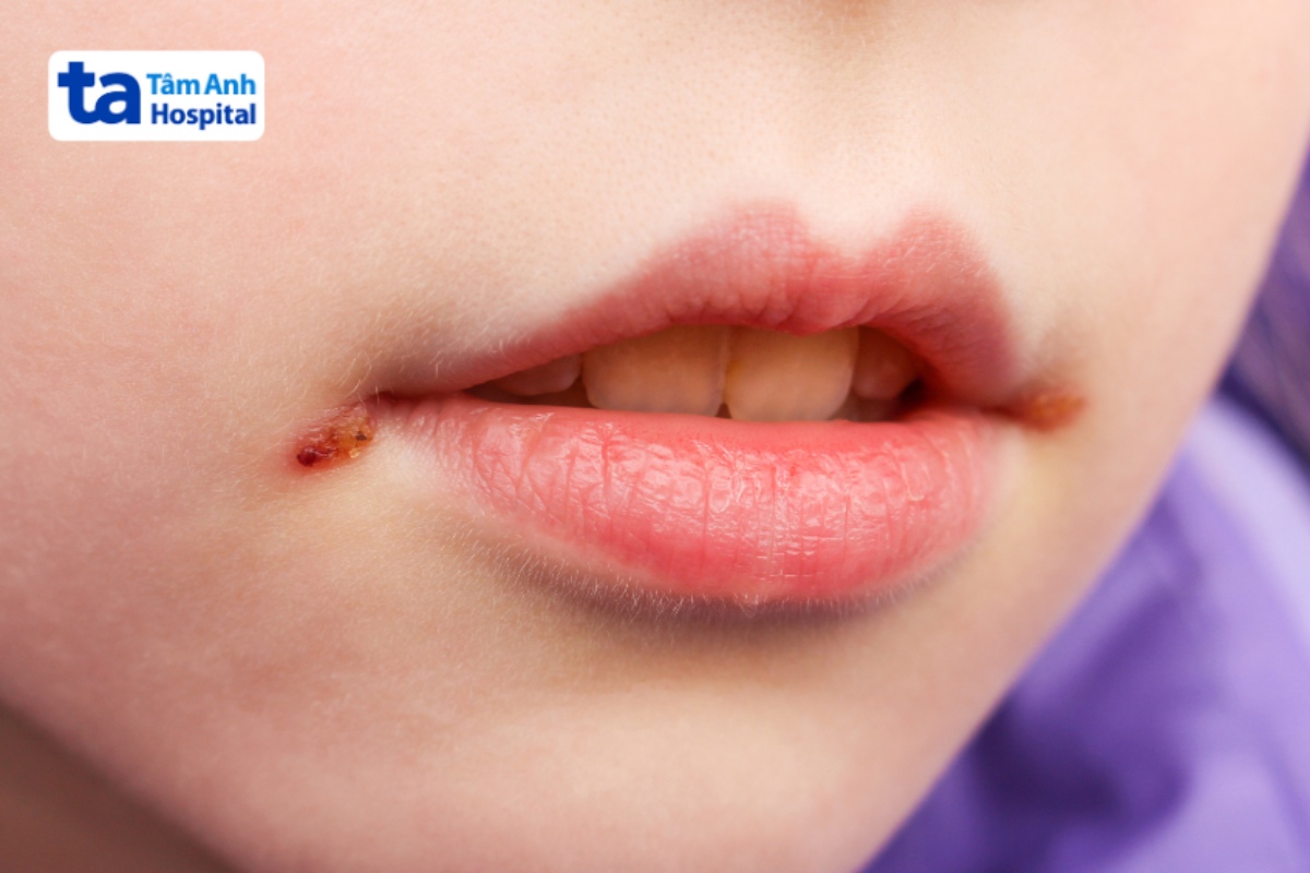 herpes ở môi trẻ