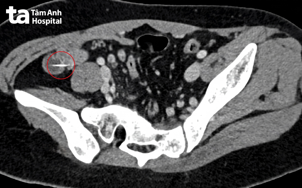 hình ảnh CT ổ bụng có dị vật