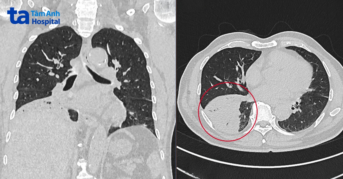 hình ảnh ct scan ghi nhận khối đông đặc ở toàn bộ thùy dưới phổi bên phải