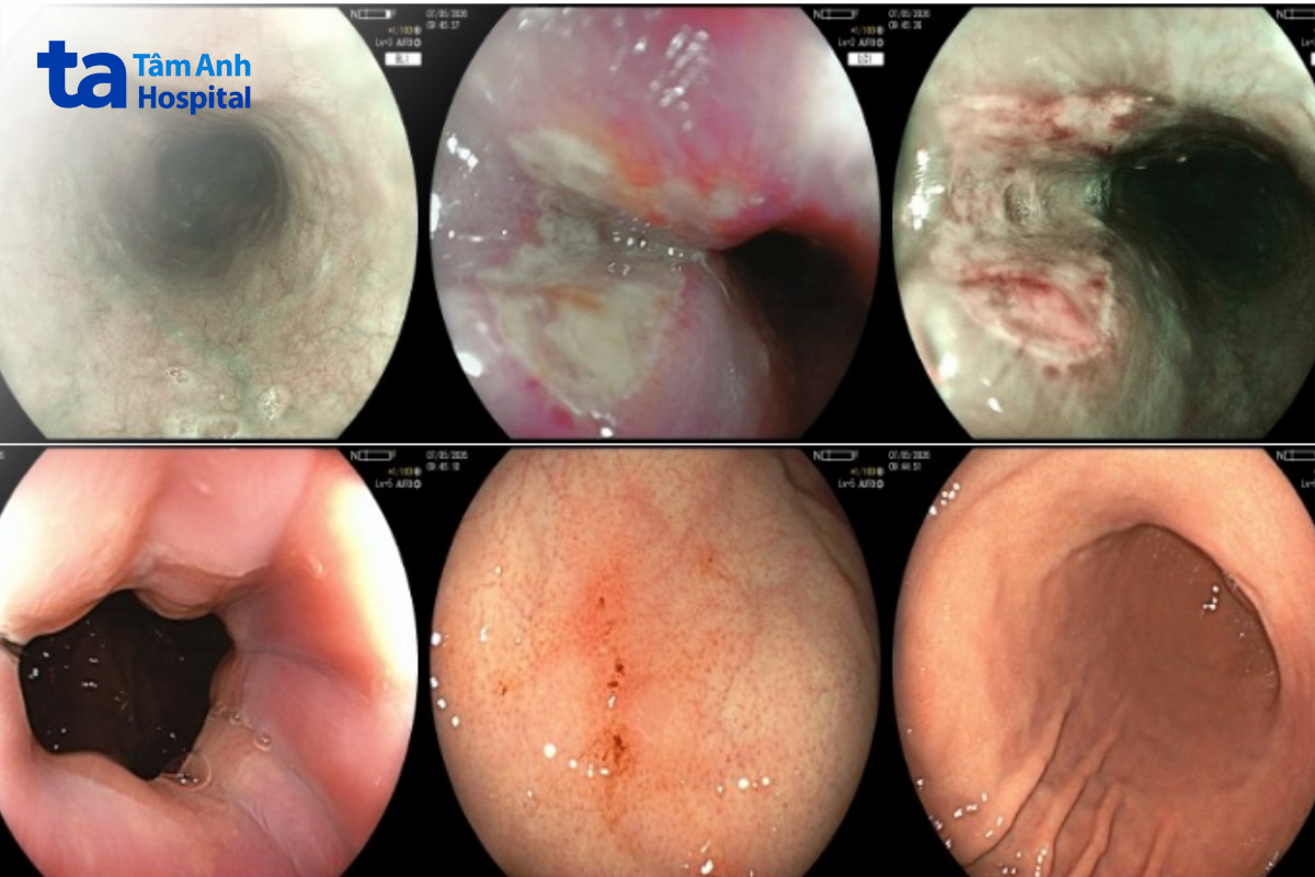Hình ảnh nội soi thực quản - dạ dày ghi nhận ổ loét thực quản