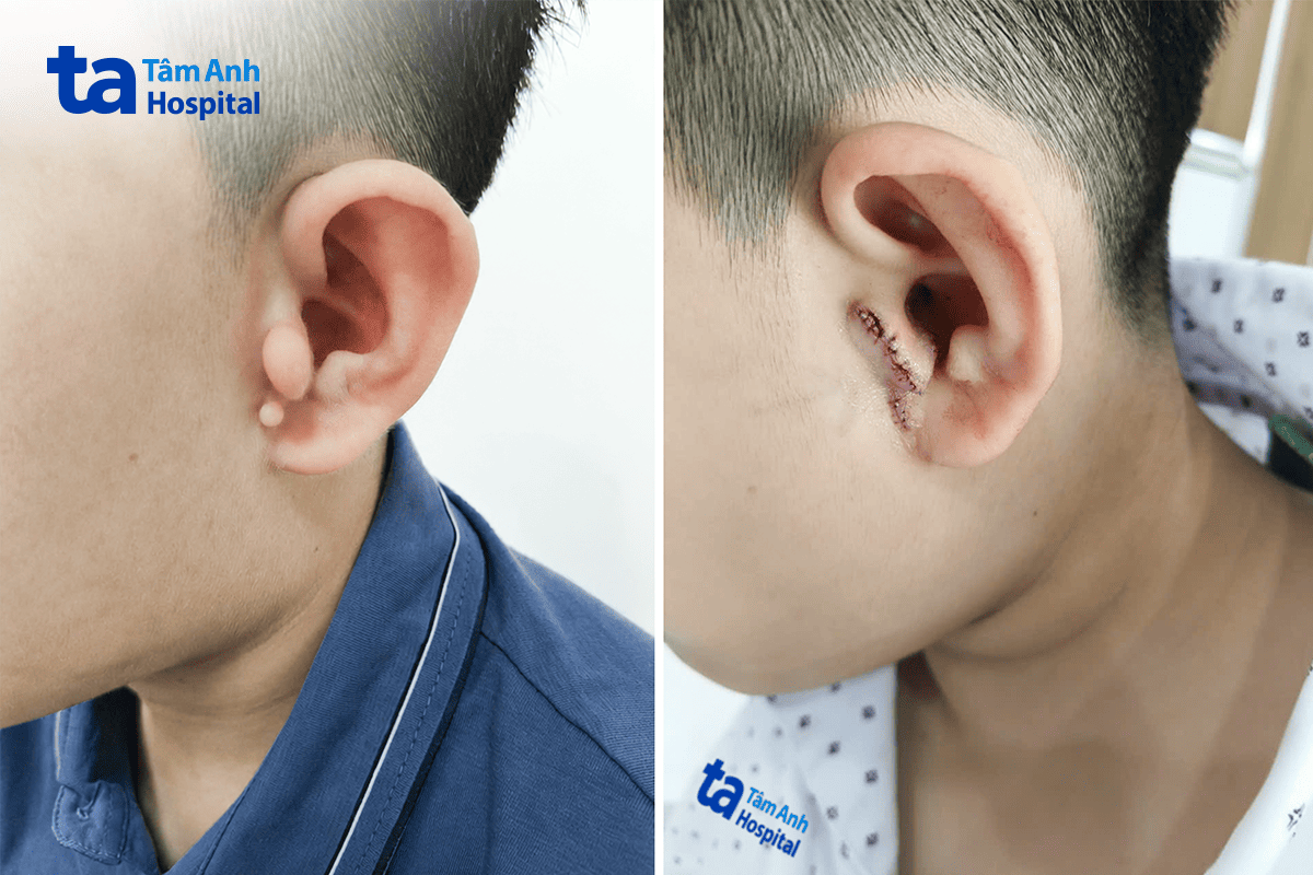 hình ảnh vành tai của thành trước phẫu thuật (trái) và sau phẫu thuật (phải)