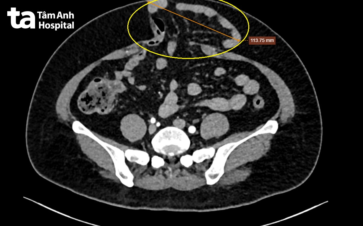 hình CT thấy lỗ thoát vị