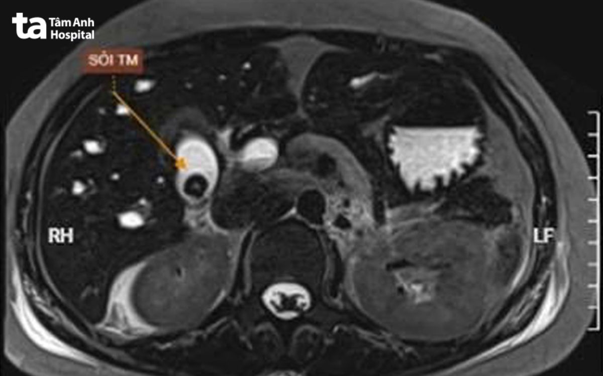 hình MRI cho thấy sỏi túi mật