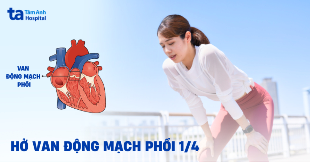 Hở van động mạch phổi 1/4 có đáng lo ngại?
