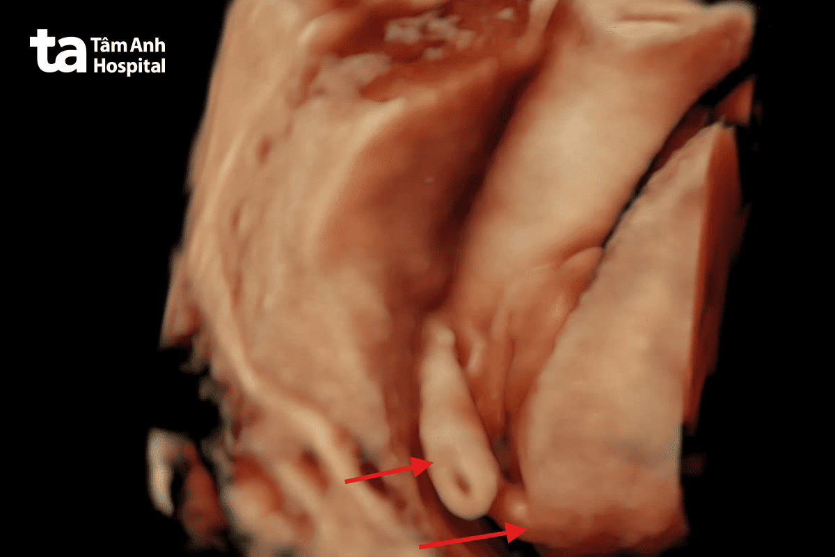 kết của chụp mri thai nhi cho thấy khối thai ký sinh ở vùng mông