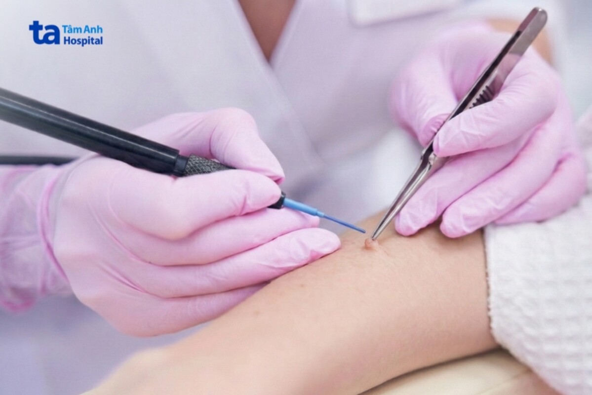 khách hàng điều trị u mềm lây bằng đốt điện