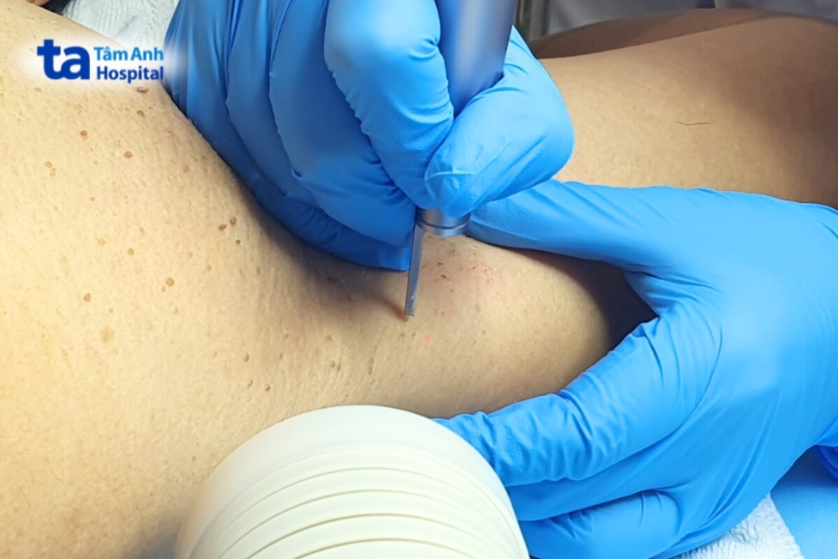 khách hàng điều trị u mềm treo bằng laser co2 tại tâm anh