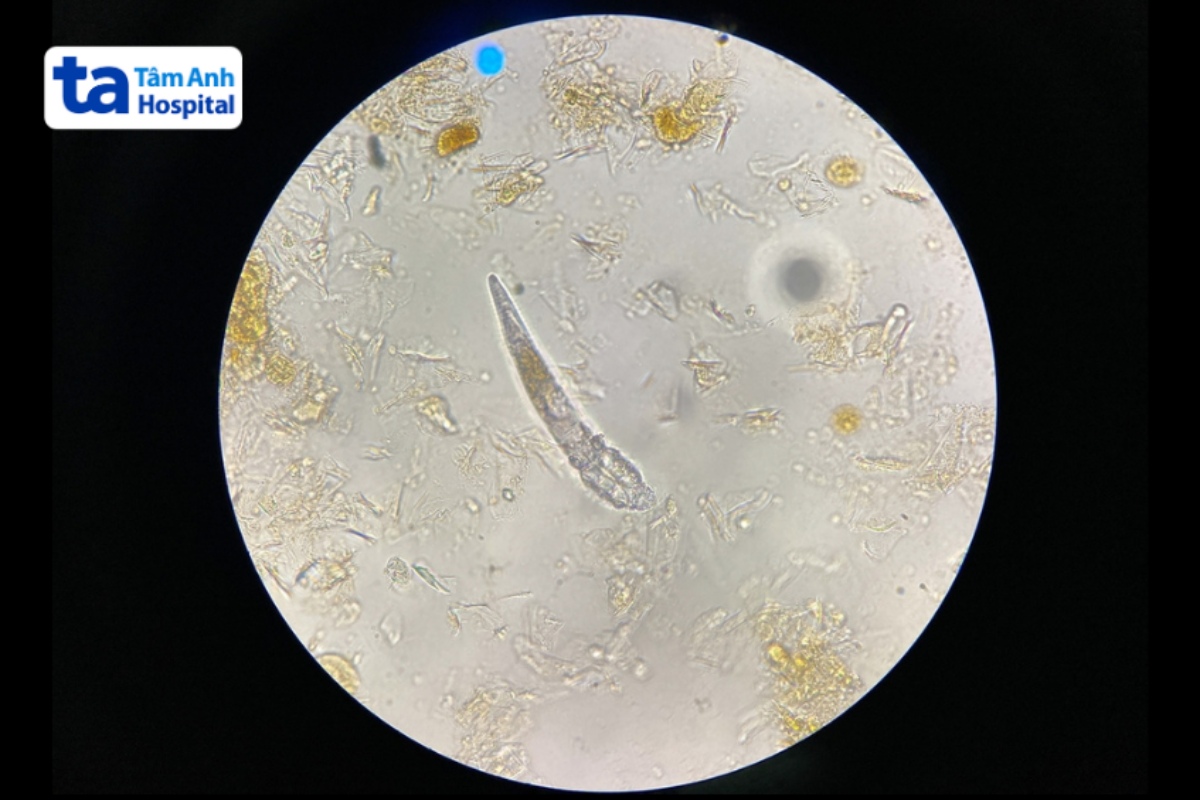 ký sinh trùng demodex