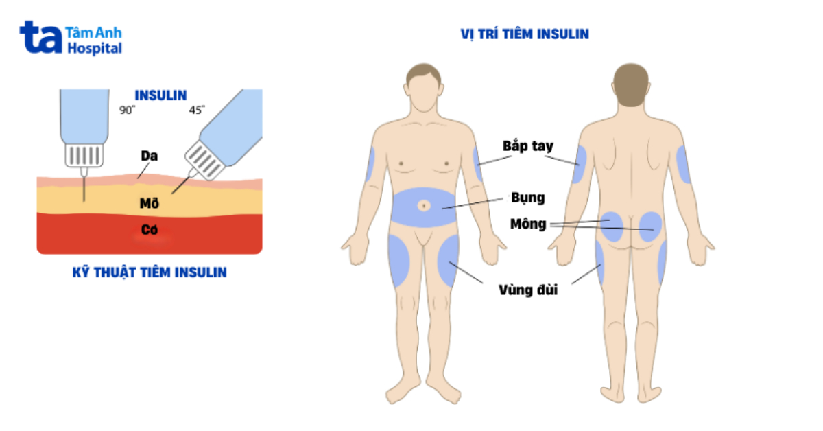 kỹ thuật tiêm insulin cho người bệnh tiểu đường