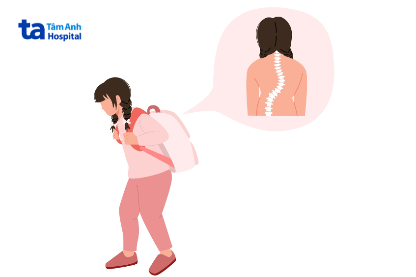 Mang cặp quá nặng là yếu tố làm tăng nguy cơ cong vẹo cột sống ở học sinh