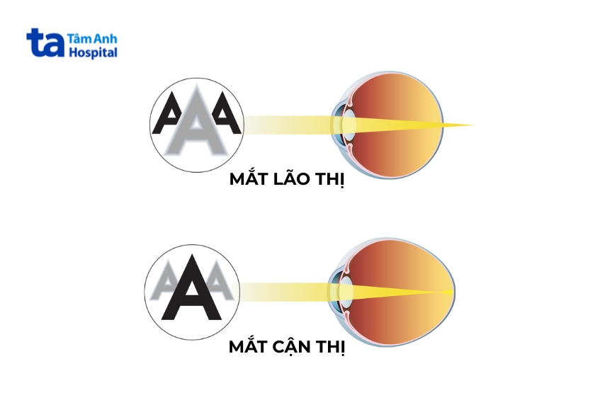 mắt cận và mắt lão