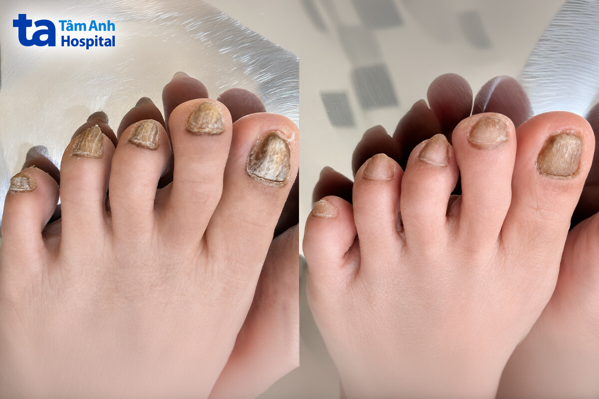 móng đã cải thiện sau 6 tháng điều trị