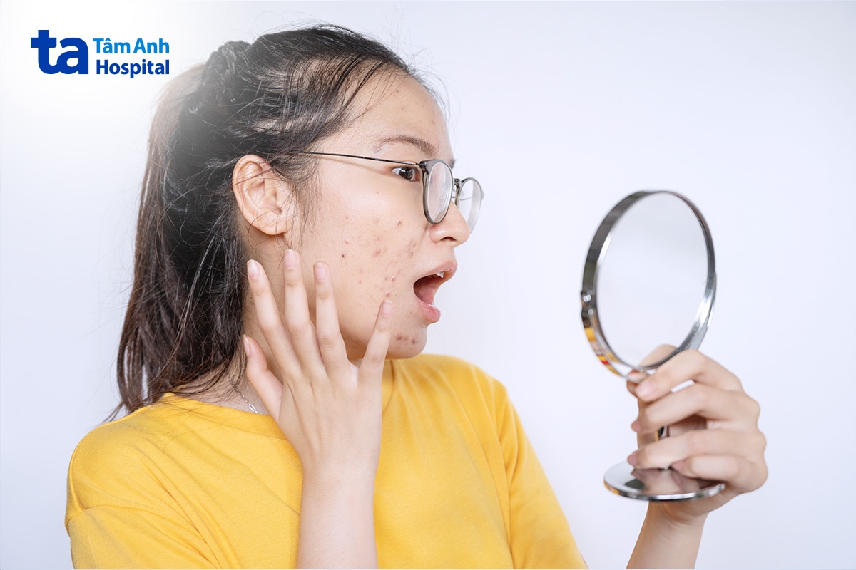Mụn trứng cá có thể xuất hiện khi nội tiết thay đổi ở tuổi dậy thì.