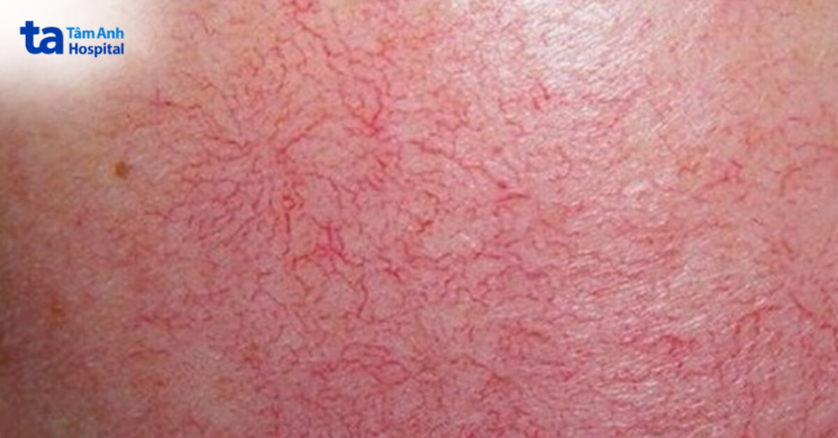 nguy cơ khi lăn kim trên nền da nhiễm corticoid