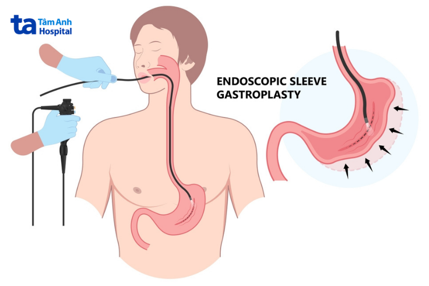 Đi Ngoài Phân Đen Là Bệnh Gì? Sẽ Gây Vấn Đề Không? Bị Tiêu Chảy Phân Đen