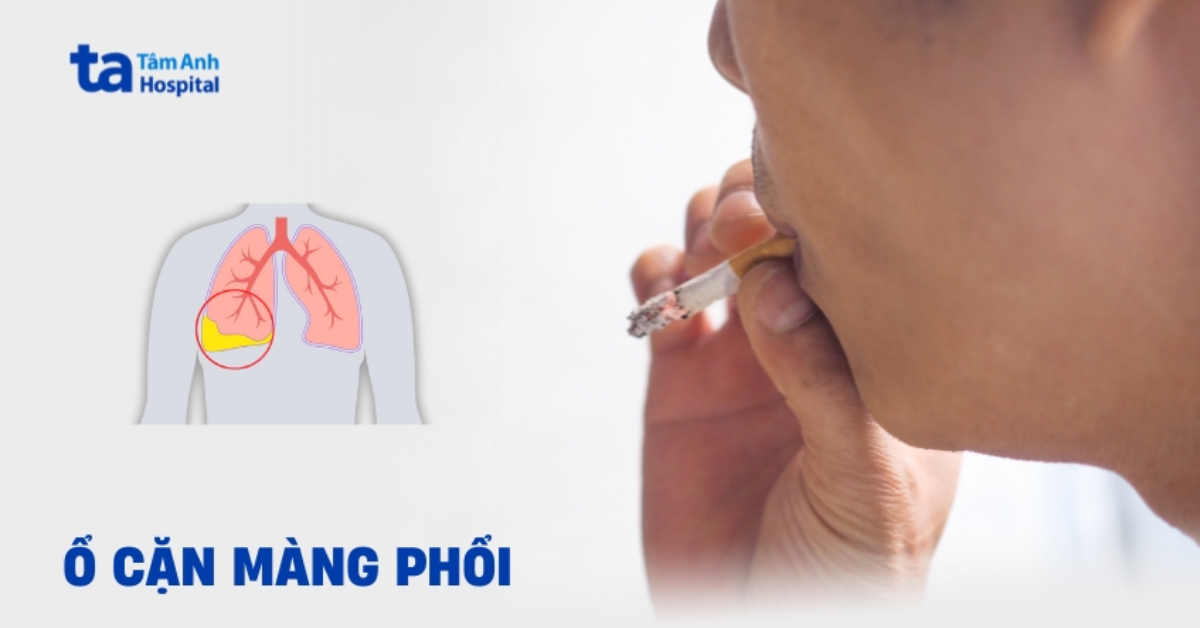 Ổ cặn màng phổi có nguy hiểm không? Khi nào cần phẫu thuật?