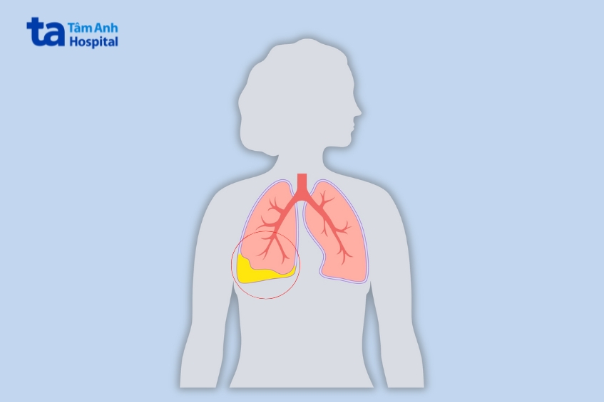 ổ cặn màng phổi là giai đoạn mạn tính của viêm mủ màng phổi